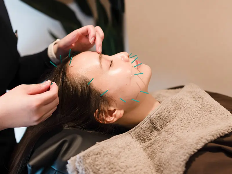 美容鍼イメージ