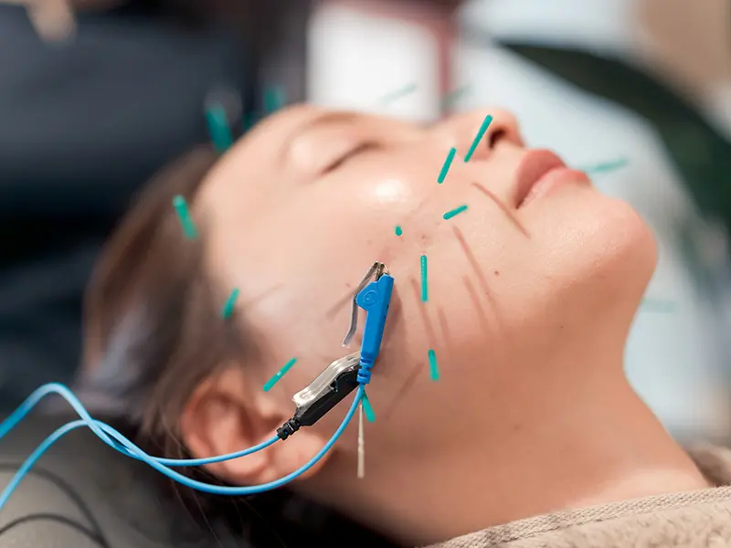 美容鍼イメージ